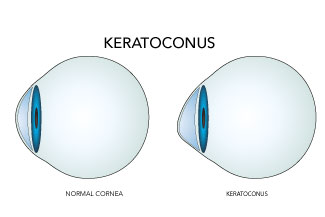 keratoconus thumbnail.jpg