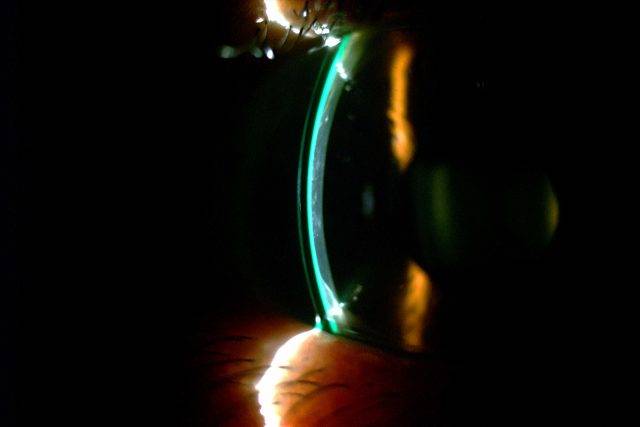 Scleral Lens RA Transplant 1280×853