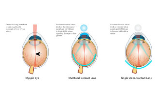 soft multifocal thumbnail.jpg
